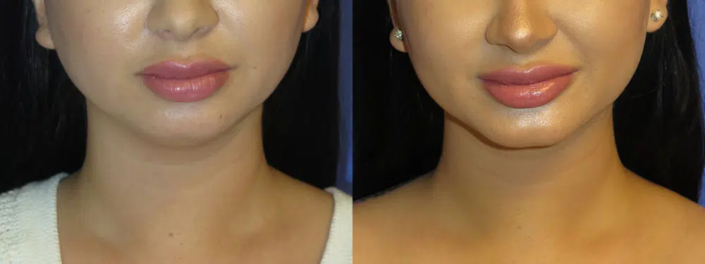 chin implant before and after photo by faceology md in newport beach ca