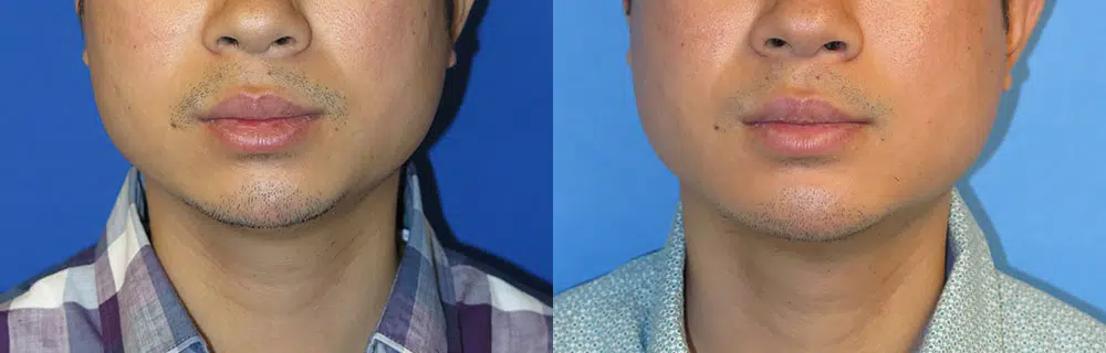 chin implant before and after photo by faceology md in newport beach ca