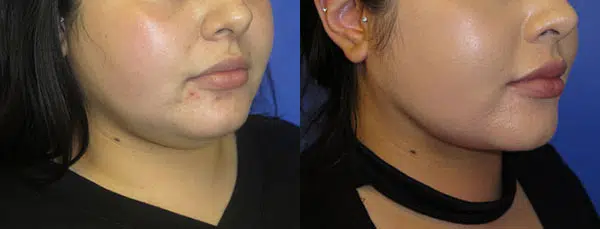buccal fat reduction before and after photo by faceology md in newport beach ca