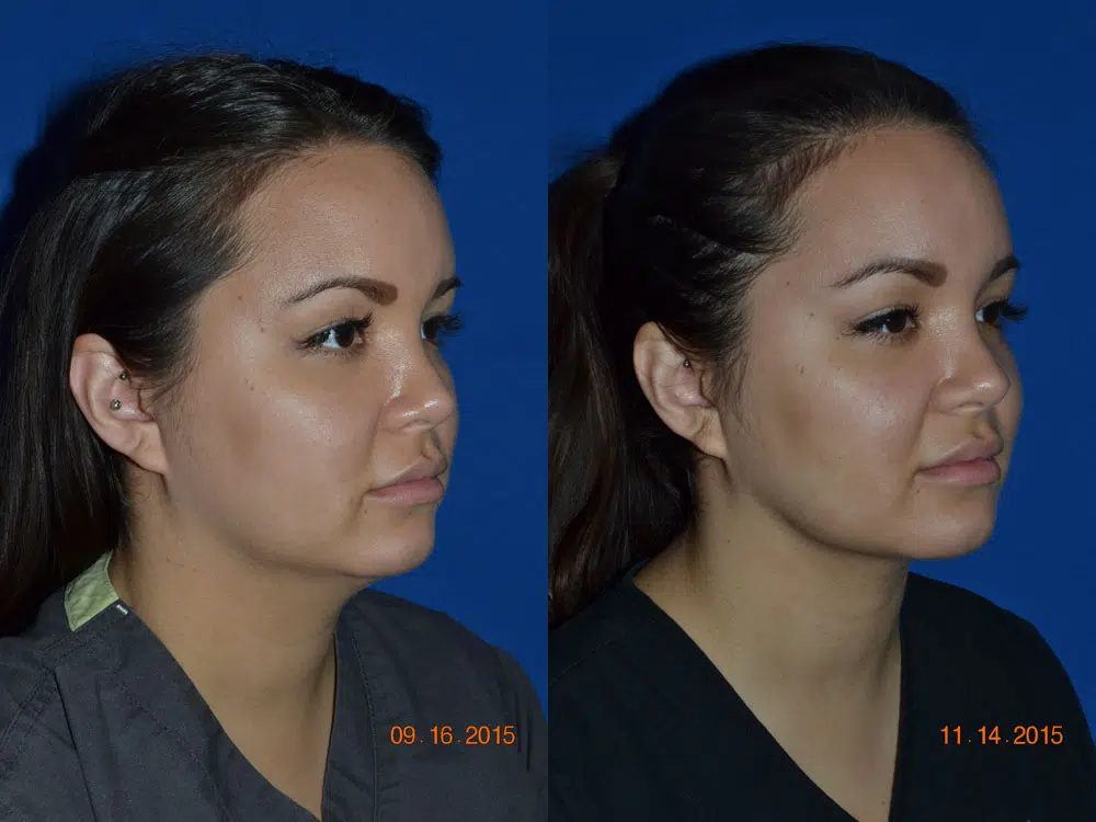 buccal fat reduction before and after photo by faceology md in newport beach ca