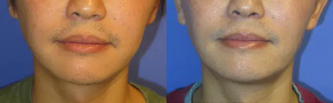 buccal fat reduction before and after photo by faceology md in newport beach ca