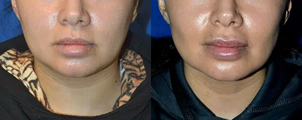 buccal fat reduction before and after photo by faceology md in newport beach ca