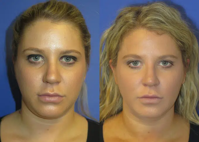 buccal fat reduction before and after photo by faceology md in newport beach ca