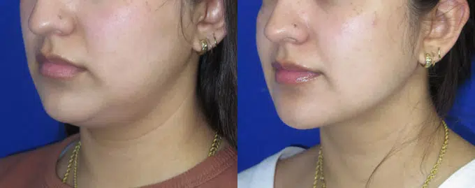 neck lipo before and after photo by faceology md in newport beach ca