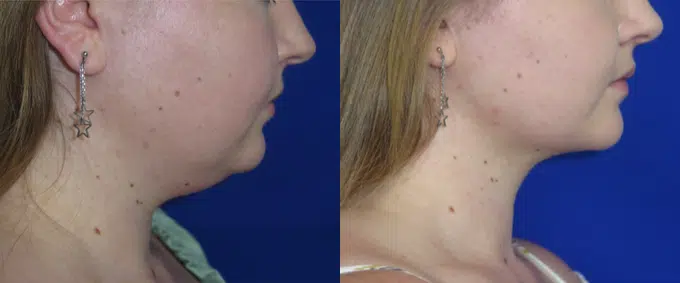 neck lipo before and after photo by faceology md in newport beach ca