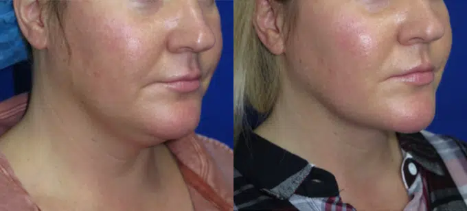 neck lipo before and after photo by faceology md in newport beach ca