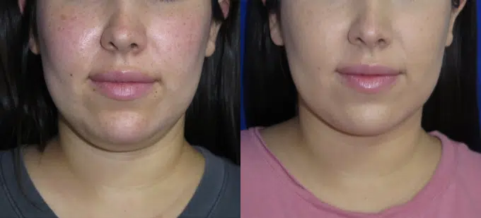 neck lipo before and after photo by faceology md in newport beach ca