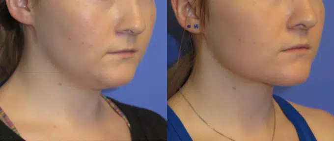 neck lipo before and after photo by faceology md in newport beach ca
