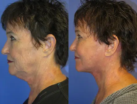 laser resurfacing before and after photo by faceology md in newport beach ca