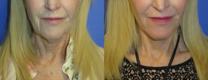 laser resurfacing before and after photo by faceology md in newport beach ca