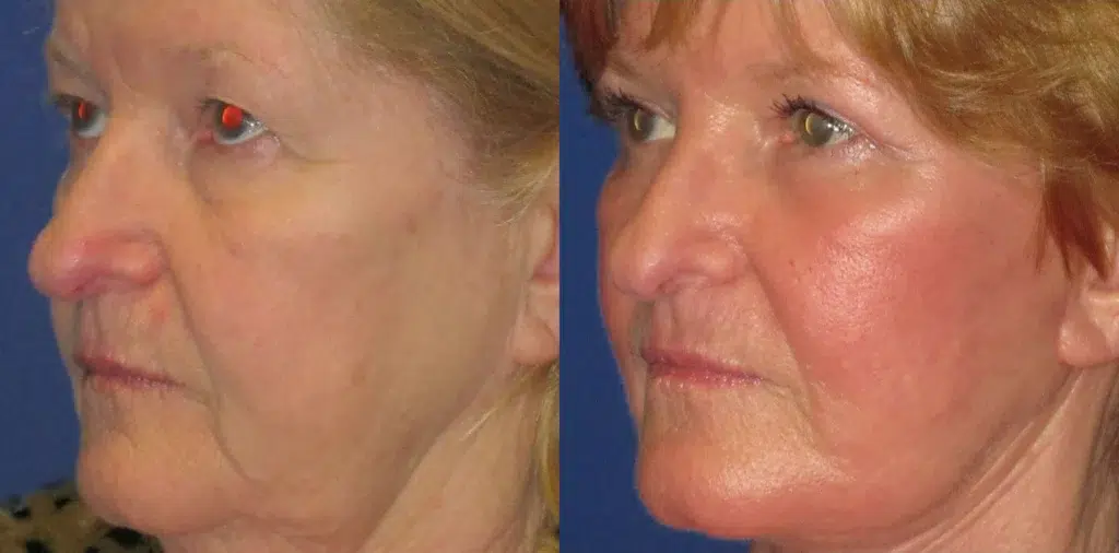 laser resurfacing before and after photo by faceology md in newport beach ca