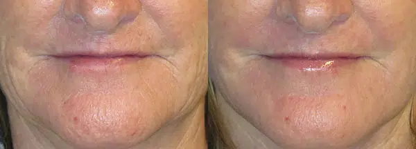 laser resurfacing before and after photo by faceology md in newport beach ca