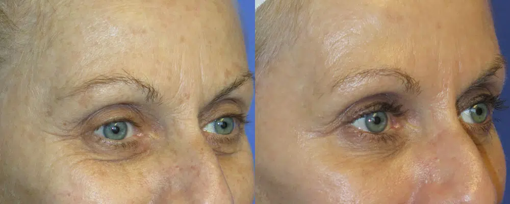 laser resurfacing before and after photo by faceology md in newport beach ca