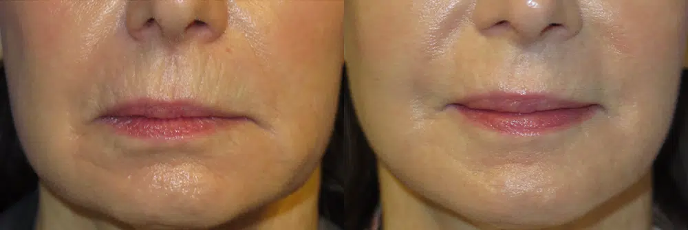 laser resurfacing before and after photo by faceology md in newport beach ca