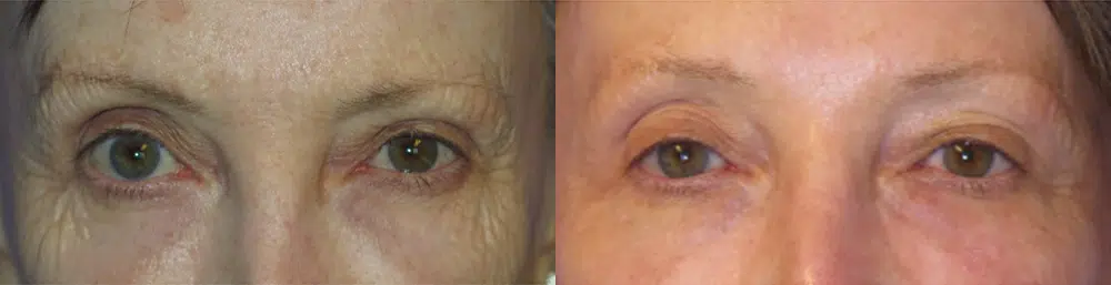 laser resurfacing before and after photo by faceology md in newport beach ca