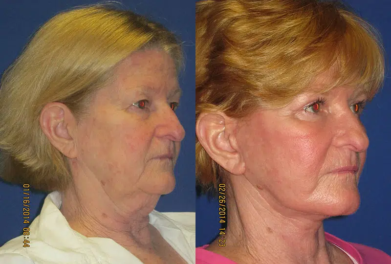 laser resurfacing before and after photo by faceology md in newport beach ca