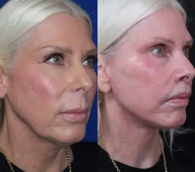 lip augmentation before and after photo by faceology md in newport beach ca