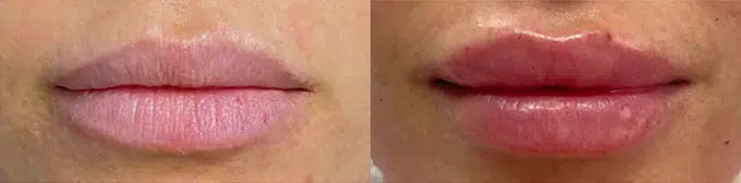 lip augmentation before and after photo by faceology md in newport beach ca