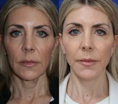 lip augmentation before and after photo by faceology md in newport beach ca
