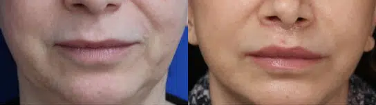 lip augmentation before and after photo by faceology md in newport beach ca