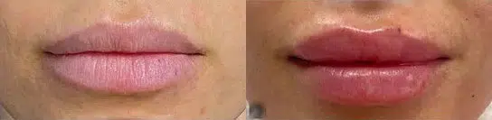 lip augmentation before and after photo by faceology md in newport beach ca