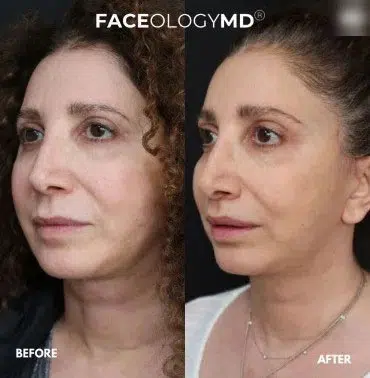 lip augmentation before and after photo by faceology md in newport beach ca