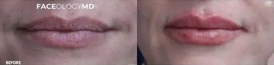 lip augmentation before and after photo by faceology md in newport beach ca
