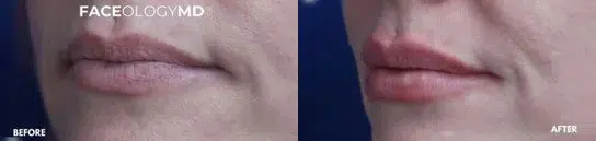 lip augmentation before and after photo by faceology md in newport beach ca lip augmentation before and after photo by faceology md in newport beach ca