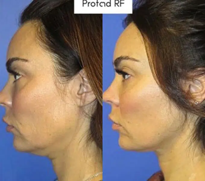profound before and after photo by faceology md in newport beach ca