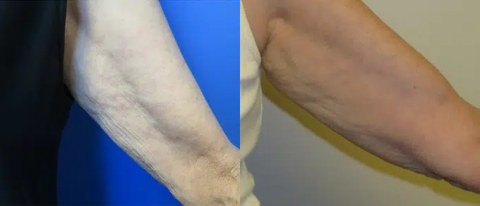 profound before and after photo by faceology md in newport beach ca