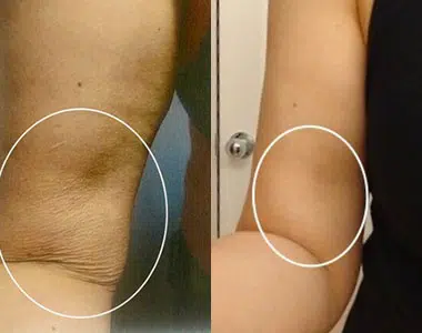 profound before and after photo by faceology md in newport beach ca