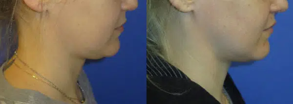 profound before and after photo by faceology md in newport beach ca