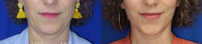 mini facelift before and after photo by faceology md in newport beach ca