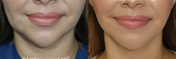 mini facelift before and after photo by faceology md in newport beach ca