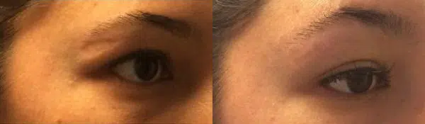 bellafill before and after photo by faceology md in newport beach ca