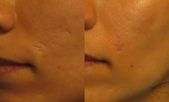 bellafill before and after photo by faceology md in newport beach ca