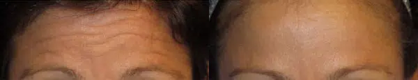 botox before and after photo by faceology md in newport beach ca