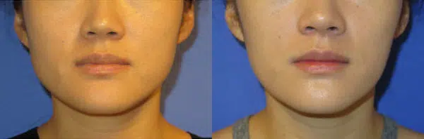 botox before and after photo by faceology md in newport beach ca