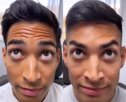 botox before and after photo by faceology md in newport beach ca