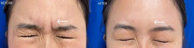 botox before and after photo by faceology md in newport beach ca