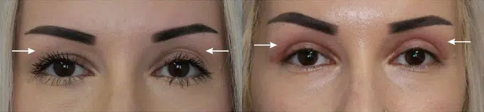 botox before and after photo by faceology md in newport beach ca