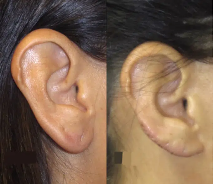 ear surgery before and after photo by faceology md in newport beach ca