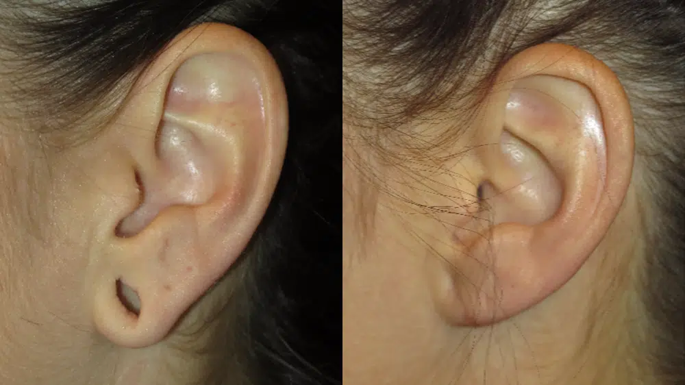 ear surgery before and after photo by faceology md in newport beach ca