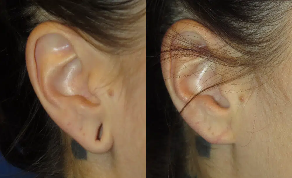 ear surgery before and after photo by faceology md in newport beach ca