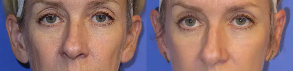 ear surgery before and after photo by faceology md in newport beach ca