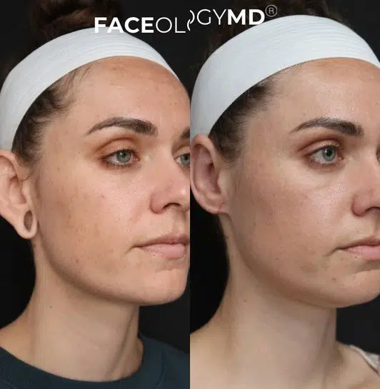 ear surgery before and after photo by faceology md in newport beach ca