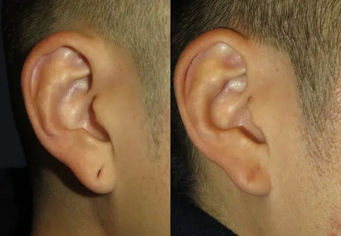 ear surgery before and after photo by faceology md in newport beach ca
