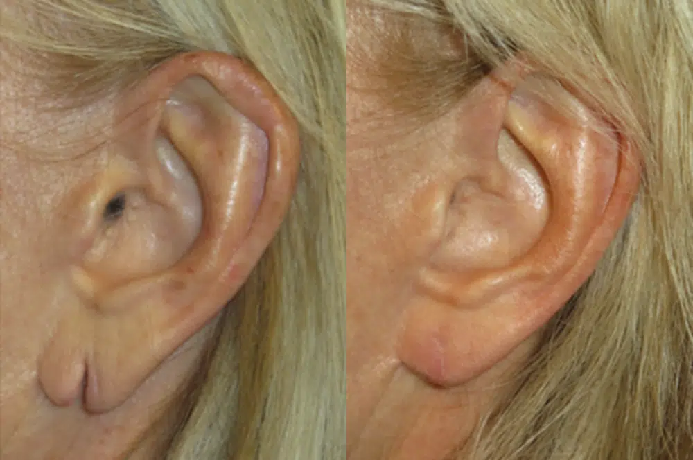 ear surgery before and after photo by faceology md in newport beach ca
