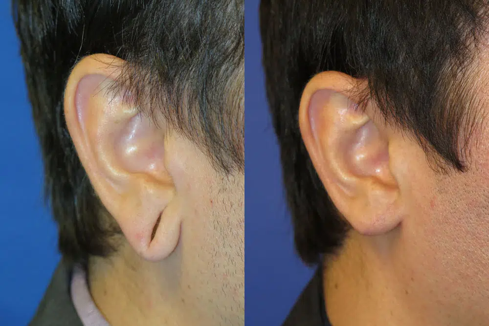 ear surgery before and after photo by faceology md in newport beach ca