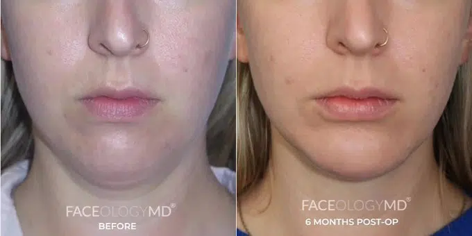 chin liposuction before and after photo by faceology md in newport beach ca